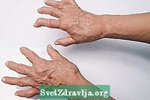 Què és l’artritis, els símptomes, el diagnòstic i el tractament - Aptitud
