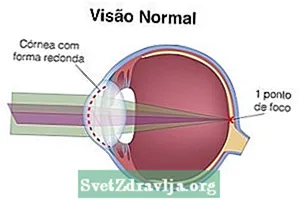 Čo je astigmatizmus, ako ho identifikovať a liečiť