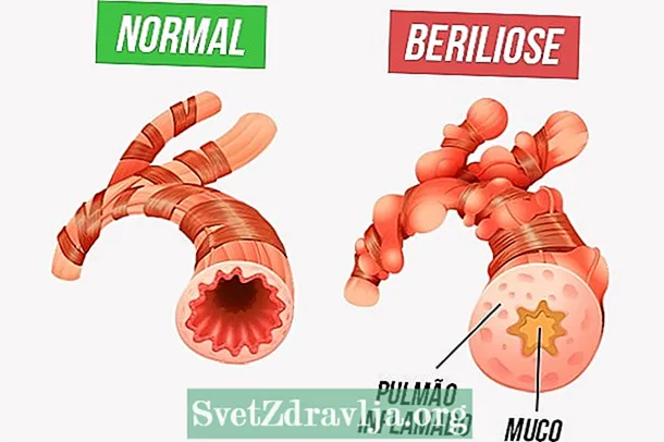 Yini i-berylliosis nendlela yokwelapha