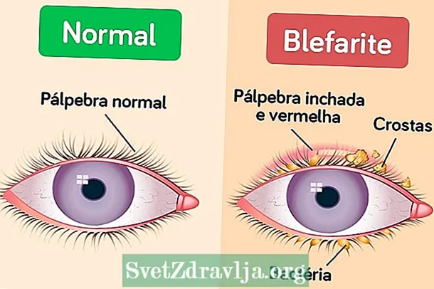 Unsa ang blepharitis (hubag nga eyelid) ug kung giunsa pagtratar
