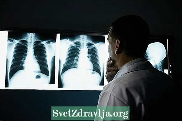 Уушигны бронхоэктаз гэж юу вэ, түүнийг хэрхэн эмчилдэг