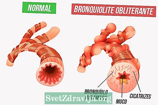 Çfarë është bronkioliti obliterans, simptomat, shkaqet dhe si të trajtohet