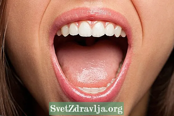 Kaj je oralna kandidoza, simptomi in kako zdraviti