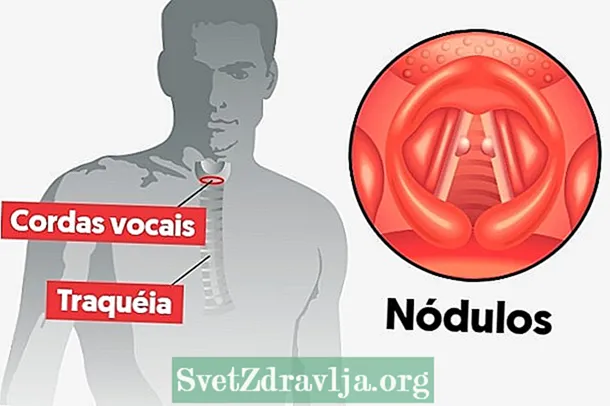 Zer kausa eta nola ekidin kaloiak ahots akordetan