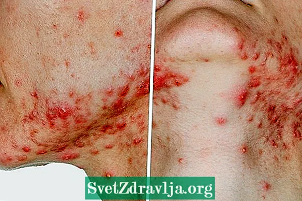Quines són les causes i com tractar l'acne fulminant