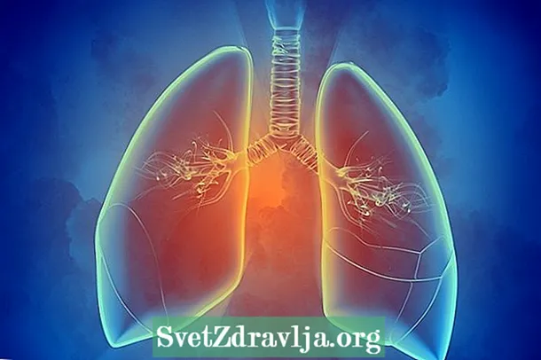 Kas yra plaučių scintigrafija ir kam ji skirta
