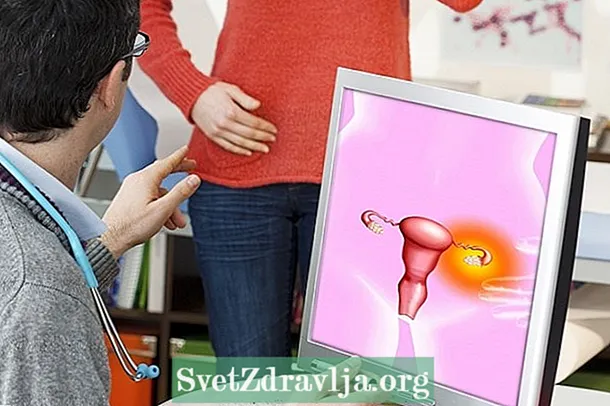 Naon kista ovarium, gejala utama sareng jinis naon