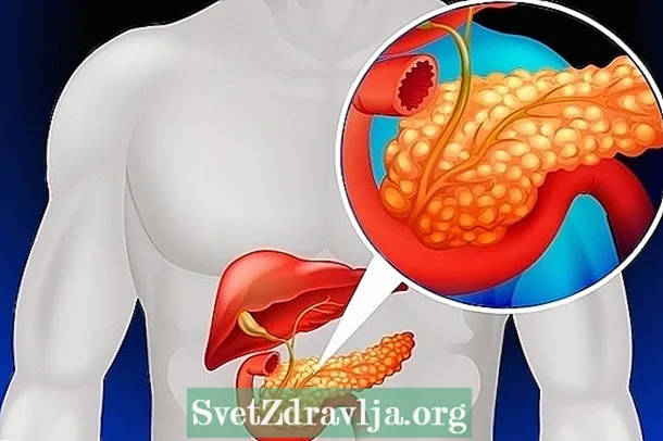 Que é o insulinoma, principais síntomas e tratamento - Saúde