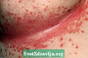 Hvað er Candidiasis intertrigo og meginorsakir