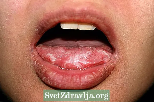 ما هو الحزاز المسطح في الفم وكيفية علاجه