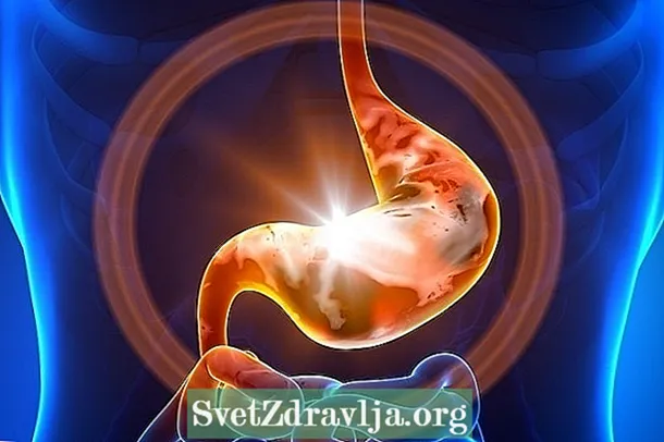 Què és la metaplàsia intestinal, els símptomes i com es tracta