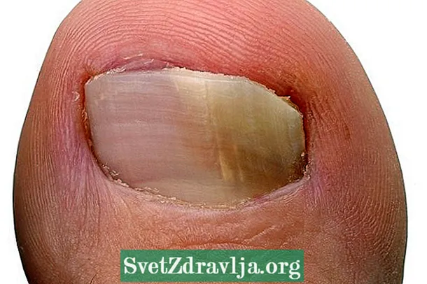 Qu'est-ce que la mycose des ongles (onychomycose), les symptômes et comment traiter
