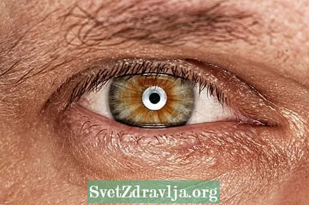 視神経炎とは何ですか？
