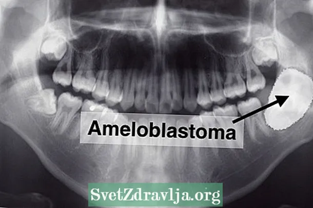 Kaj je Ameloblastom in kako ga zdraviti
