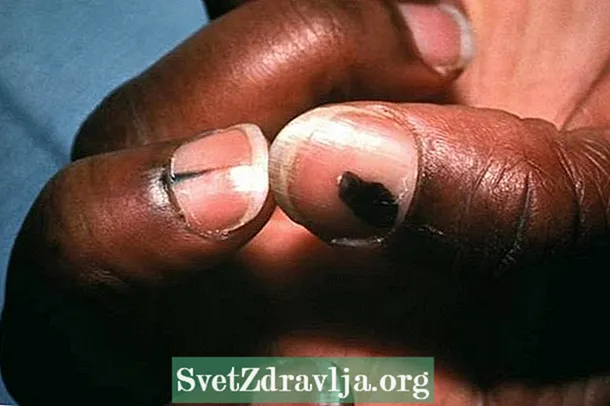 Šta je melanom noktiju, simptomi i liječenje