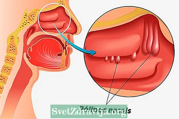 Kodi polyp nasal, zizindikiro ndi chithandizo - Thanzi