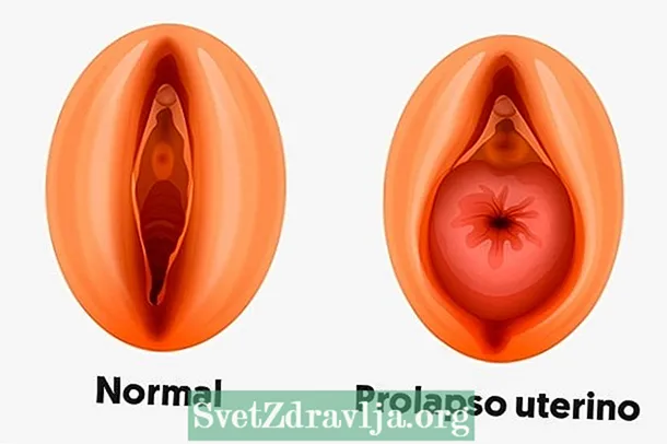 Wat is uterine prolaps, haadsymptomen en behanneling