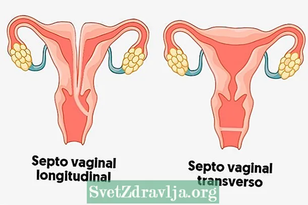 Gịnị bụ mmamiri septum na otú e si na-emeso