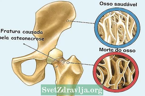 Čo je osteonekróza a ako ju identifikovať