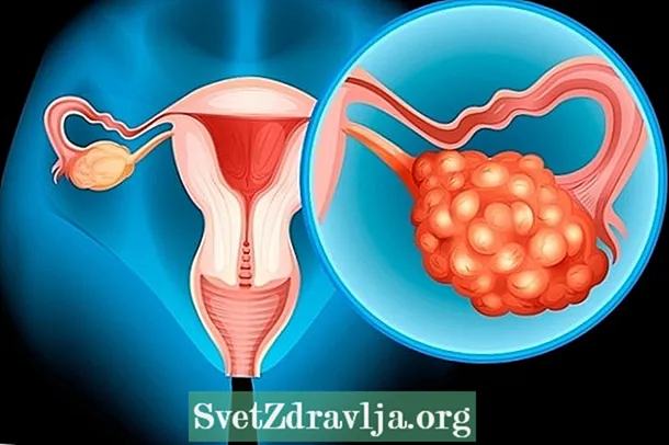Unsa ang polycystic ovary, simtomas ug panguna nga pagduhaduha