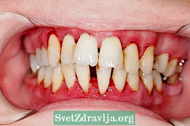 Yini i-periodontitis, izimpawu nokwelashwa