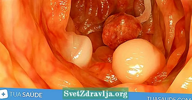 Què és el pòlip intestinal, símptomes, causes i tractament