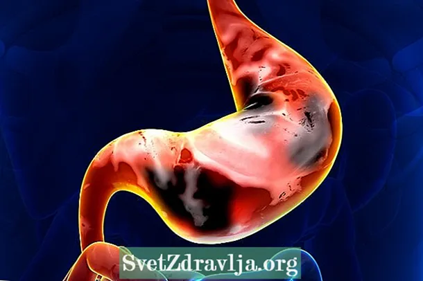 ¿Qué puede causar sangrado digestivo superior o inferior?
