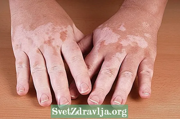 Apa yang dapat menyebabkan Vitiligo dan cara mengobatinya