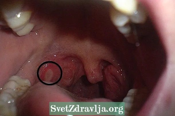Què pot tenir l’herpes labial a la gola i com curar-lo? - Aptitud
