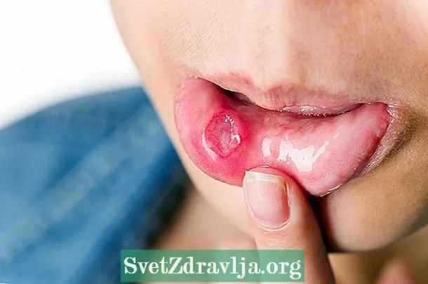 Τι μπορεί να είναι και πώς να θεραπεύσετε τον πόνο στο στόμα