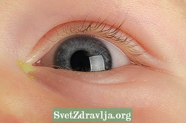 ¿Qué pueden ser Eyes Remelando en Baby? - Aptitud Física