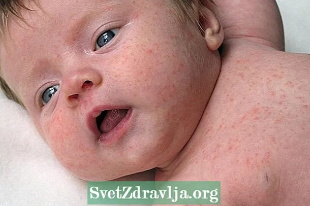 Was können die Murmeln im Gesicht des Babys sein und was zu tun ist
