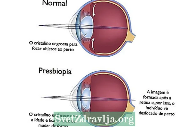 Presbyopia ndi chiyani, zizindikilo zake ndi momwe angachiritsire