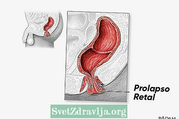 X'inhu prolapse tar-rektum, kawżi, sintomi u trattament