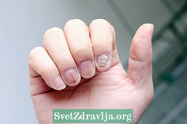 Šta je psorijaza noktiju, glavni simptomi i liječenje