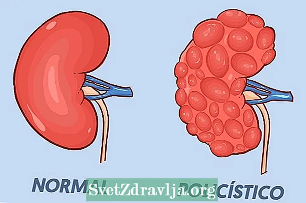 多発性嚢胞腎とは何ですか？