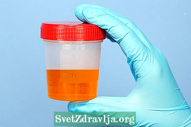 Mida tähendab bilirubiin uriinis ja mida teha