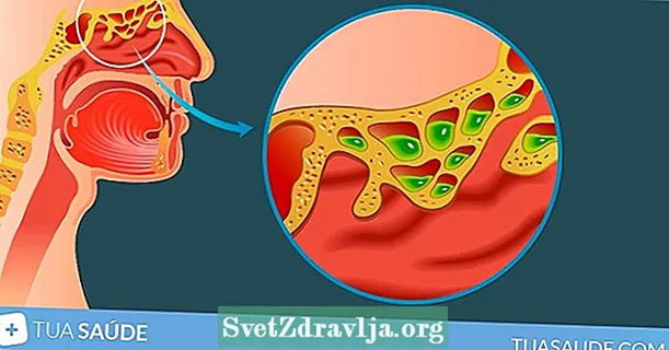 Šta je sinusitis, glavni uzroci i kako liječiti