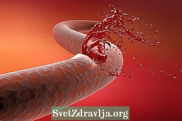 Ce este sângerarea internă, care sunt simptomele, cauzele și tratamentul