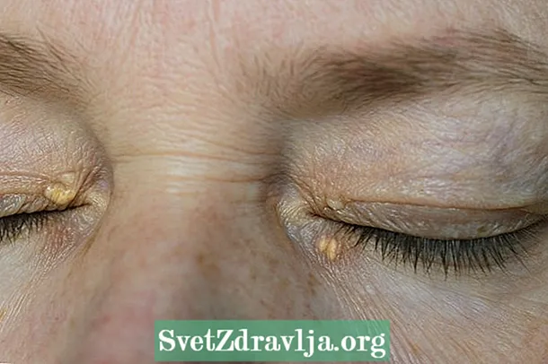 Wat is xanthelasma, oorsake en behandeling