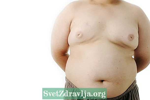 मोर्बिड मोटापा: यो के हो, कारण र उपचार - स्वास्थ्य