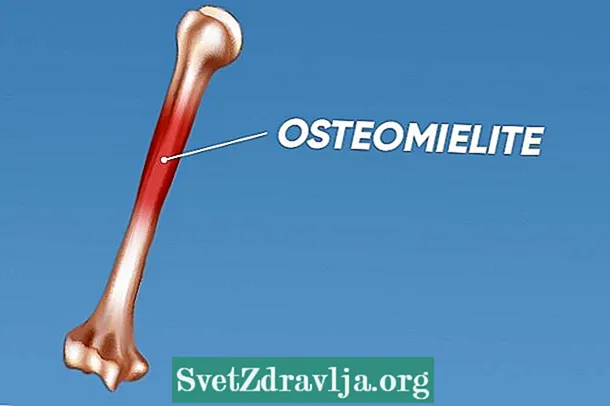 Osteomyelitis: wat et ass, Symptomer a Behandlung