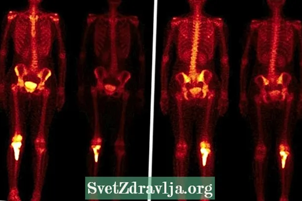 Nws yog dab tsi rau thiab thaum twg tag nrho lub cev scintigraphy tas? - Noj Qab Haus Huv