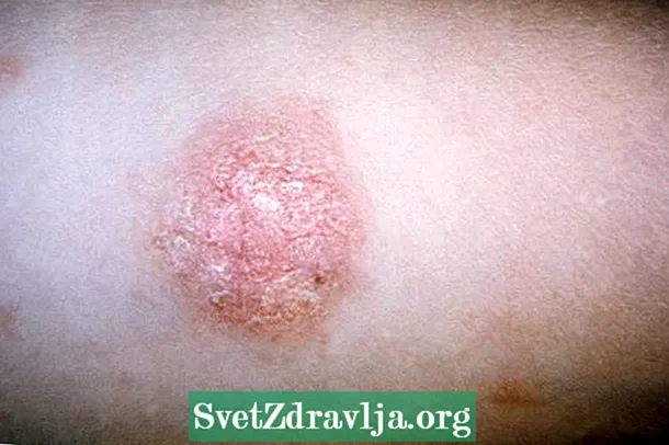 Розова питиријаза: што е тоа, симптоми, причини и третман