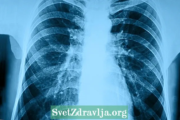Ligoninės pneumonija: kas tai yra, priežastys ir kaip ją gydyti