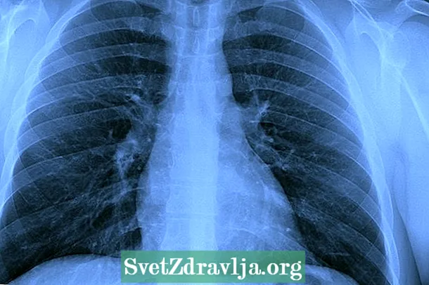 Pneumothorax: Was es ist, Symptome, Arten und Behandlung