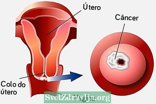 Glavni uzroci raka vrata maternice