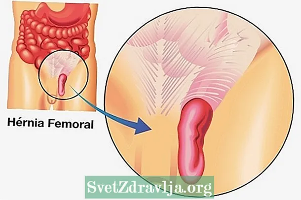 Belangrijkste symptomen van femorale hernia, oorzaken en hoe de behandeling wordt uitgevoerd