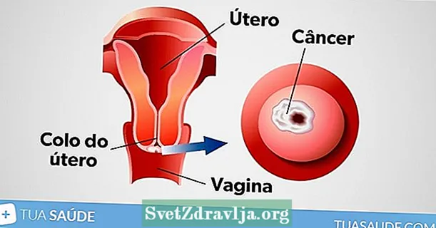 Haaptsymptomer vun Gebärmutterkriibs