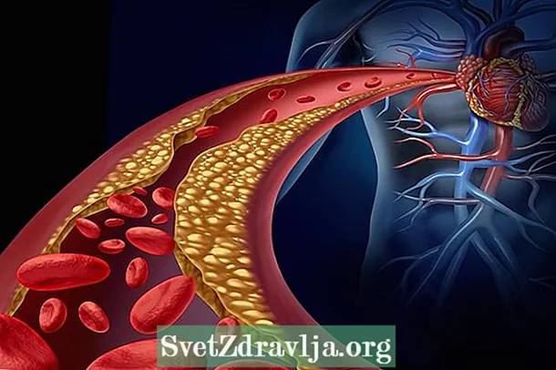 Principali tipi d'angina, sintomi è cumu trattà - Salute